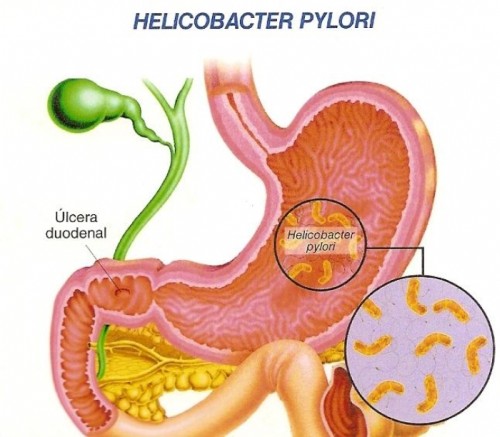 gastrite cronica helicobacter pylori